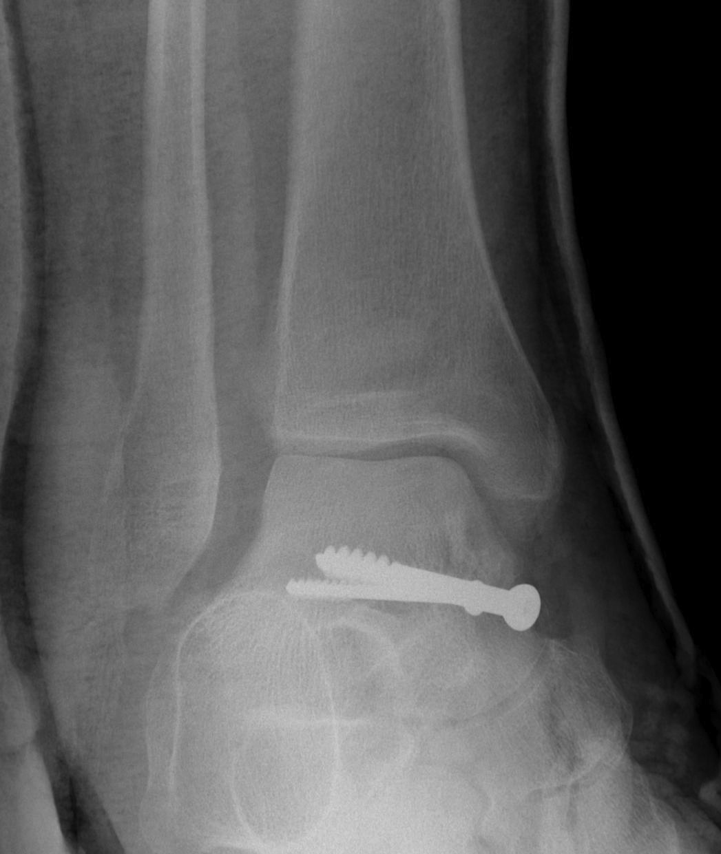 Ankle Diastasis